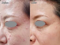 脂 腺 増殖 症 ブログ