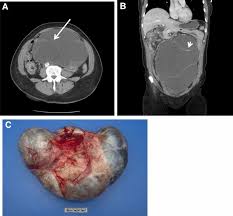 ovarian serous neoplasms can have morphologic overlap with malignant mesothelioma. Borderline Epithelial Ovarian Tumors What The Radiologist Should Know Springerlink