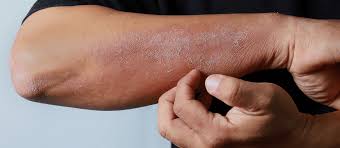 Image result for Atopic eczema atopic dermatitis