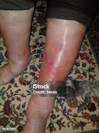 Image result for erysipel photos)