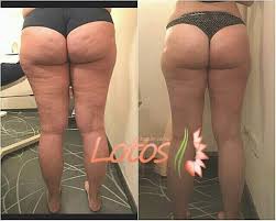 Before and after photos were inflammatory rash. Maderotherapy Maderotherapy