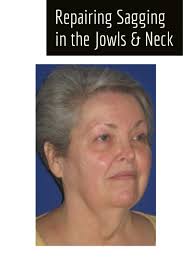 The Number One Cause Of Sagging Jowls The Lower Cheek And Jaw Areas On Either Side Of The Mouth Is Natural Agi Face Lift Surgery Facelift Facial Rejuvenation