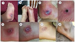 Image result for infected tick bite
