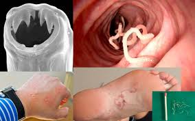Human Hookworm Infection Can Cause Rapid Acute Cognitive Impairments Https Debuglies Com