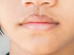 Busted Lip: 9 Treatments And Home Remedies