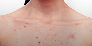 Campurkan bubuk aspirin tersebut dengan air bersih atau jika anda ingin lebih manjur, maka campurkanlah dengan madu. 5 Bahan Alami Ini Ampuh Untuk Sembuhkan Jerawat Di Badan Merdeka Com