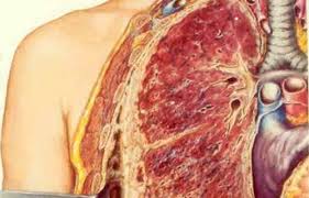 Will get the disease at some point. Health Issues Caused By Asbestos Asbestos 123