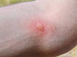 Image result for mosquito bite
