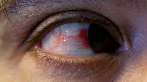 Repeat this 3 times in a day. Close Up Of Annoyed Red Human Stock Footage Video 100 Royalty Free 1030251248 Shutterstock