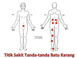 Apa tanda penyakit batu karang? Perubatan Asli Batu Karang Postingan Facebook