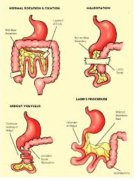 Image result for Midgut Volvulus