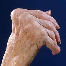 Rheumatoid Arthritis-Causes-Symptoms-Diagnosis-Treatment-Homeopathic Treatment-Best Homeopathic doctor-Dr Qaisar Ahmed-Risalpur-KPK