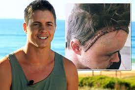 Celebrities reach out to johnny ruffo after he shares heartbreaking news his cancer has returned. Home And Away Star Johnny Ruffo Shares Harrowing Picture Of His Head Stapled Together Following Emergency Brain Tumour Surgery Mirror Online