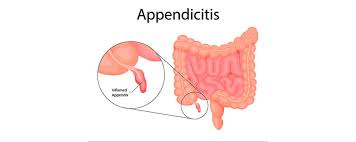 Image result for Appendicitis