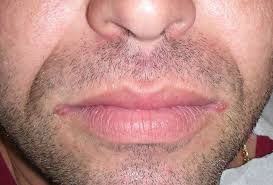 Image result for Angular Stomatitis