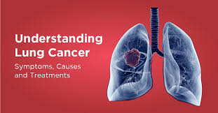 A new cough that doesn't go away coughing up blood, even a small amount Understanding Lung Cancer Symptoms Causes And Treatments Regency Healthcare Ltd Understanding Lung Cancer Symptoms Causes And Treatments