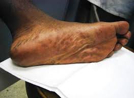 Image result for brown patches on the feet