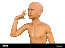 Image result for Chorea