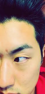 How to get rid of acne scab overnight fast? How To Treat Your Pimple Popped Wounds And Blemishes Fast