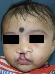Efficacy of morpho-functional repair in management of different  morphological variants of unilateral complete cleft lip