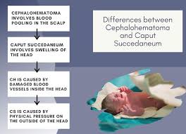 Image result for Cephalhematoma