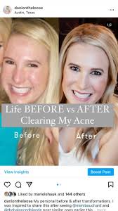 LIFE BEFORE VS AFTER CLEARING ACNE BE LIKE…, BEFORE: stressed to the max,  shitty diet, too many prescription drugs, lack of confidence and self  esteem, caking