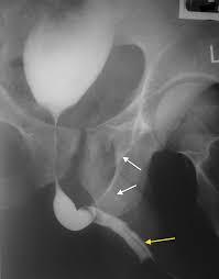 Image result for Retrograde Urethrogram