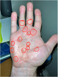 Image result for syphilis symptoms