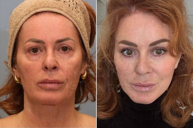 Woman, 54, Gets 'Intense' Facelift as Part of Her 'Rebrand' — Before and  After (Exclusive)