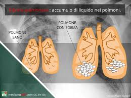 L'embolia polmonare si verifica quando una piccola massa, (embolo) nella maggior parte un coagulo di sangue, si incunea in un'arteria polmonare. Edema Polmonare Acuto Cause Sintomi E Terapia