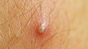 The doctor may also choose to use a small scalpel and release the trapped hair by making a small incision. How To Get Rid Of Ingrown Hair Getridofthings Com