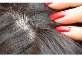 Dry Scalp Causes Symptoms And Treatment
