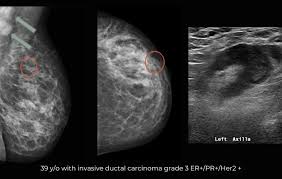 Image result for Breast Cancer Staging