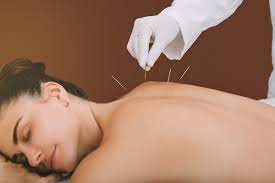 10 Health Benefits of Acupuncture for Your Mind and Body