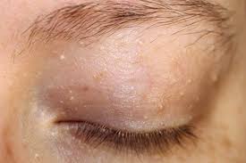 Image result for milium cyst on eyelid