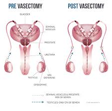 Image result for Vasectomy