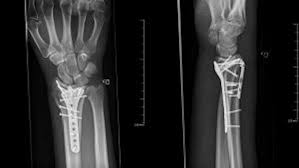 Image result for Fracture Complication