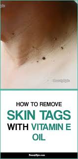 Vitamin E Oil For Skin Tag Removal Does It Work Skin Tag Removal Skin Tag Oils For Skin