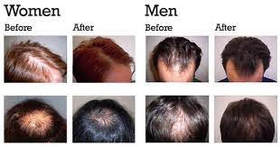 However, there are 5 things you need to avoid. Pin On Microneedling