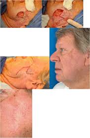 Rhombic flap. The Dufourmental modification of the rhombic flap, when...