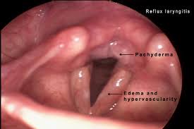 Image result for Acute Laryngitis