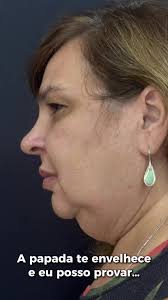 Venha conhecer o Protocolo Contorno Slim e rejuvenesça!!! Em São José do  Rio preto 💛#lipopapada #slim #sjrp #sp