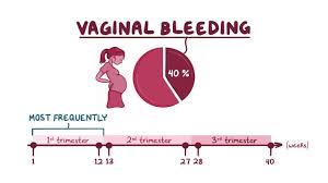While usually discovered on a second trimester ultrasound or possibly in the third, this relatively rare complication happens when the placenta. Antepartum Hemorrhage Clinical Practice Osmosis