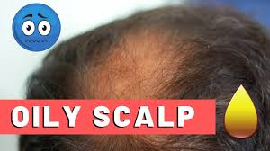 People usually suffer from hair loss because of other reasons, such as unhealthy diet and problems with blood circulation, however, there is a skin disorder called seborrhoeic dermatitis which causes dry scalp and sometimes may also lead to hair loss. Oily Scalp Hair Loss Are The Two Connected Hairguard