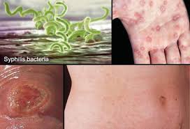 Symptoms of secondary syphilis include skin rash, swollen lymph nodes, and fever. Syphilis Picture Image On Medicinenet Com