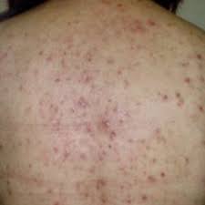 Jul 30, 2020 · morbihan disease. Pdf Morbihan Disease An Old And Rare Entity Still Difficult To Treat