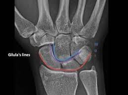 Which limb is radiographed is if the film was proximal sesamoids ergot correctly labeled image accessory carpal bone curled around and well projected. Epos