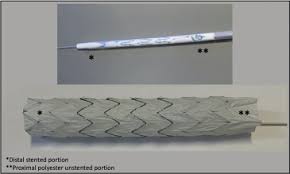 The stent has been designed to maintain patency of stenosed trachea or bronchus due to extrinsic compression caused by a tumor. First In Human Use Of The Cook Hybrid Frozen Elephant Trunk Graft The Canadian Experience The Annals Of Thoracic Surgery