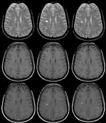 Multiple sclerosis (ms) is a condition that can affect the brain and spinal cord, causing a wide range of potential symptoms, including problems with vision, arm or leg movement, sensation or balance. Atlas De Neurologia