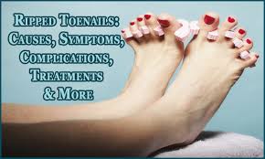 Ripped Toenails Know Its Causes Symptoms Complications Treatments More Ripped Toenails Can Toe Nails Nail Fungus Treatment Toenail Fungus Essential Oils